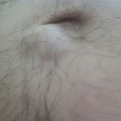 Göbek Fıtığı Fotoğrafı