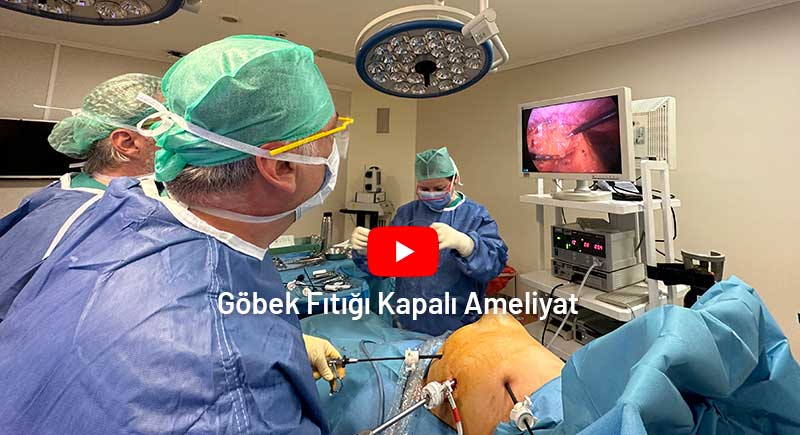 gobek fitigi kapali ameliyat videosu