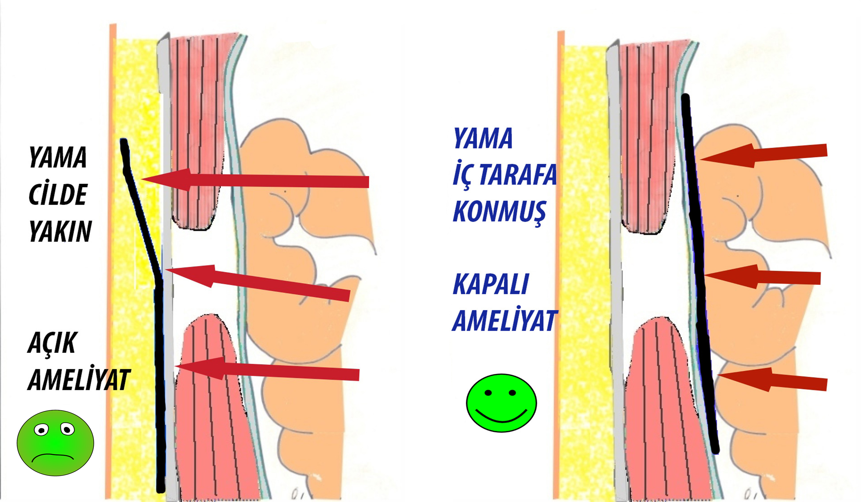 inlay-onlay.jpg
