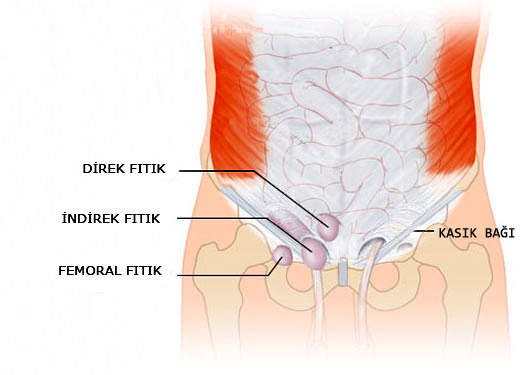 direk kasık fıtığı, indirek kasık fıtığı, femoral kasık fıtığı