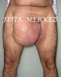 Dev Fıtıklar Dev Fıtıklar